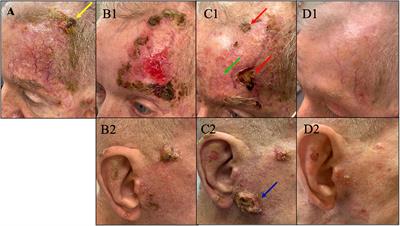 Case Report: Dostarlimab for treatment of aggressive cutaneous squamous cell carcinoma